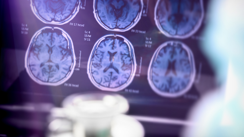 კლინიკური კვლევა: ალცჰაიმერის ექსპერიმენტული წამალი „იმედის მომცემია“